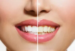 Des Plaines IL Dentist | Stained Teeth