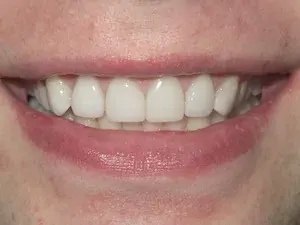 After Invisalign and whitening - smile gallery