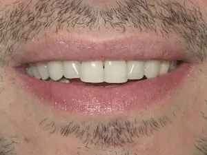 After Invisalign and whitening - smile gallery