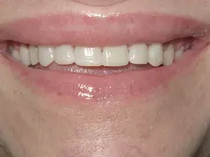 After gum disease and misaligned teeth treatment - smile gallery