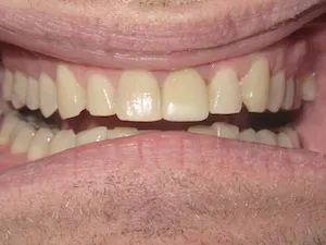 After gum disease and misaligned teeth treatment - smile gallery