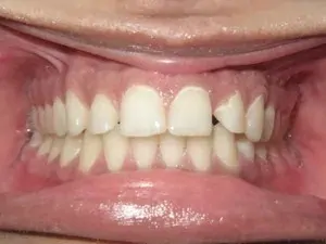 After gum disease and misaligned teeth treatment - smile gallery