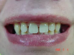 Before Invisalign and whitening - smile gallery