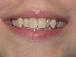 Before Invisalign and whitening - smile gallery