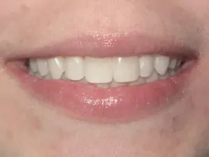 After Invisalign and whitening - smile gallery