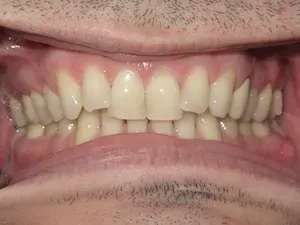 Before Invisalign and whitening - smile gallery
