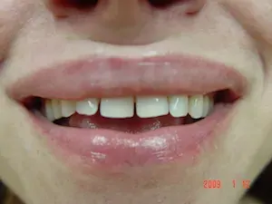 Before gum disease and misaligned teeth treatment - smile gallery