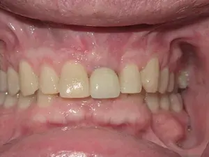 Before gum disease and misaligned teeth treatment - smile gallery