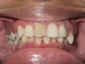 Before gum disease and misaligned teeth treatment - smile gallery