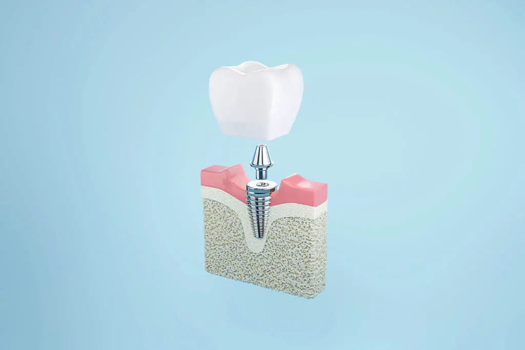 dental implants near me