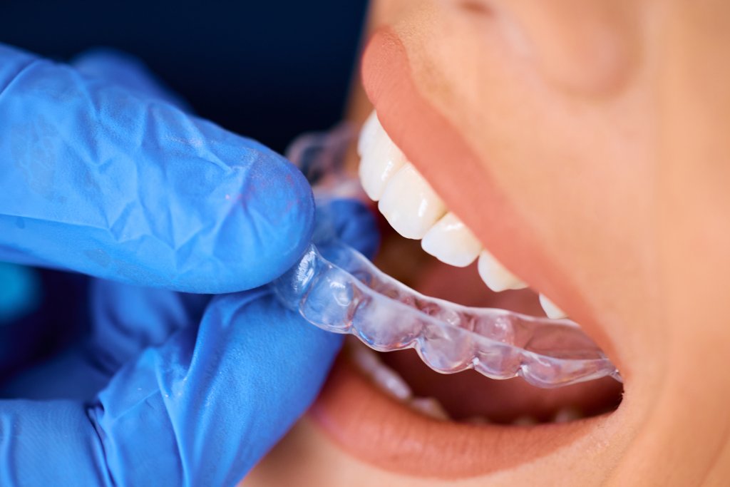 invisalign dentist near me2