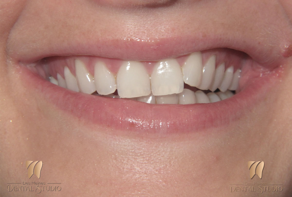 veneers before woman