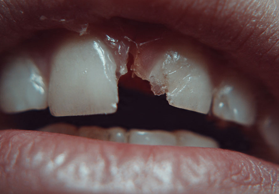 broken tooth in des plaines