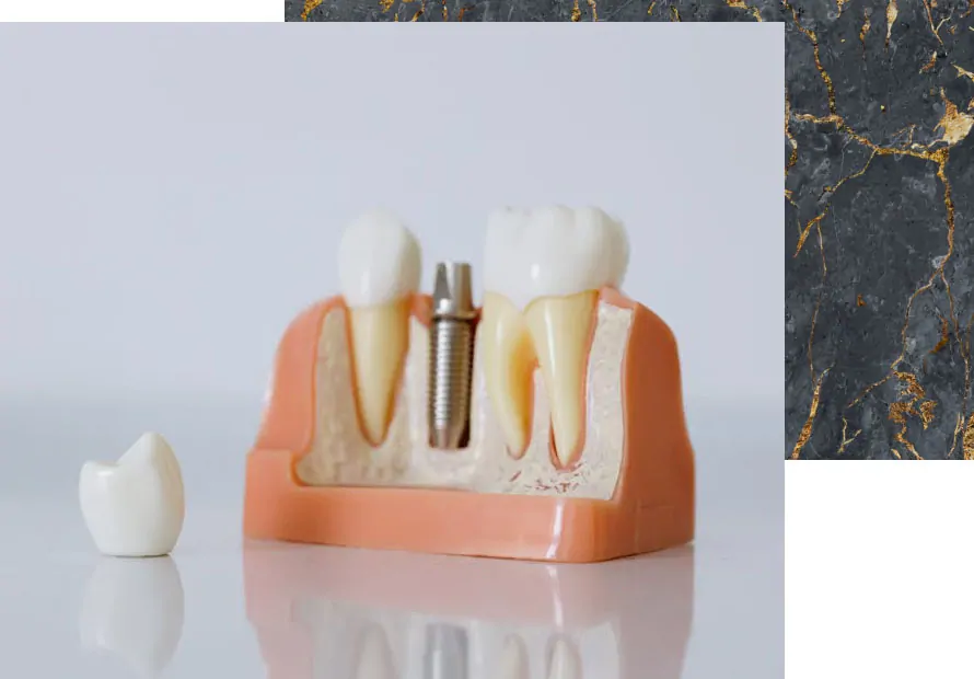 single tooth implant in des plaines