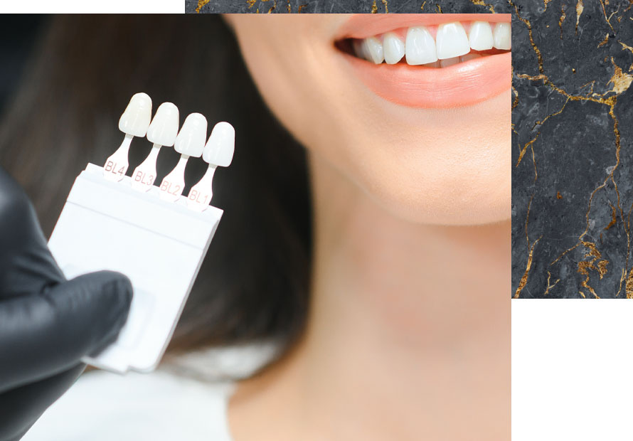 porcelain veneers des plaines