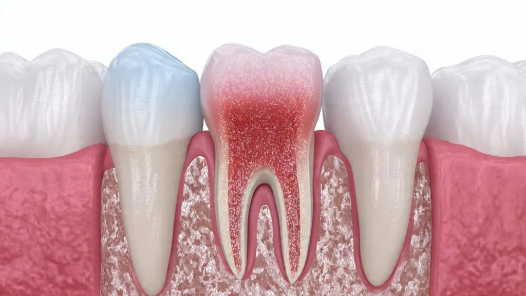 Dental abscess treatment in Des Plaines