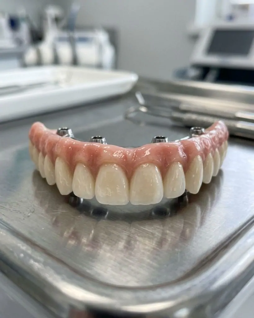 All-on-4 dental implants in Des Plaines