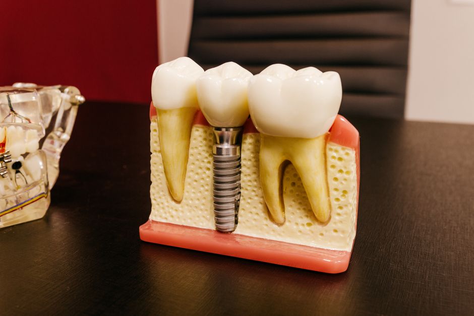 dental implants insurance