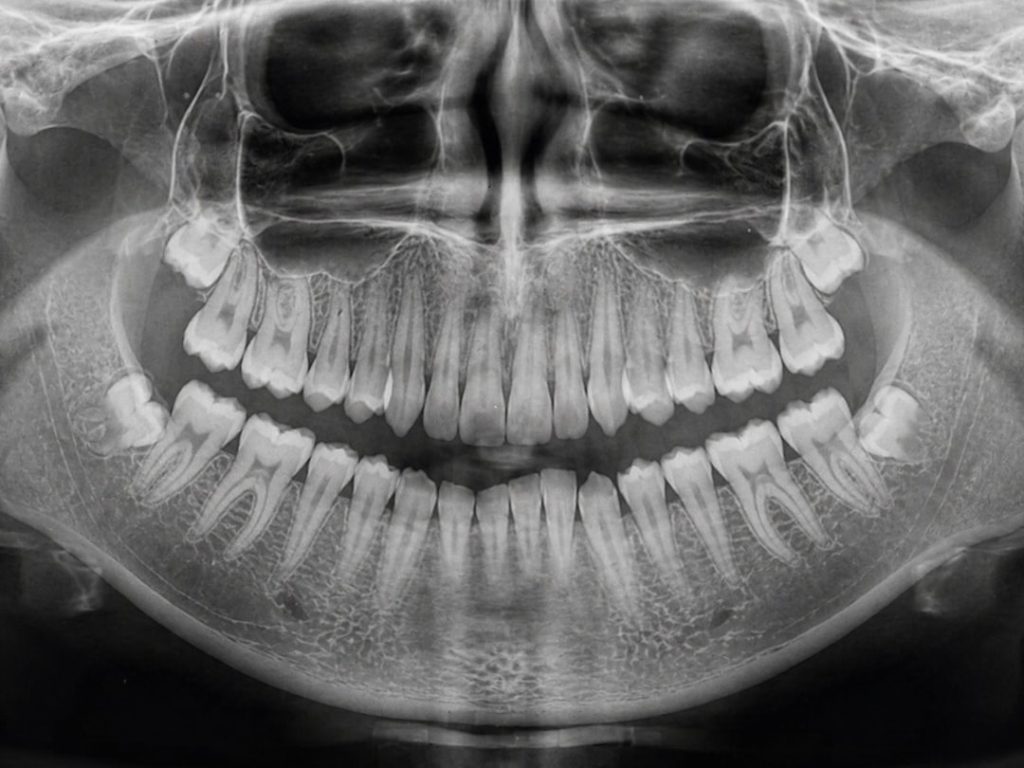 full lower jaw dental implants