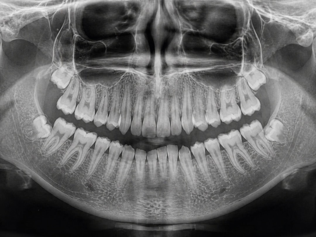 full lower jaw dental implants