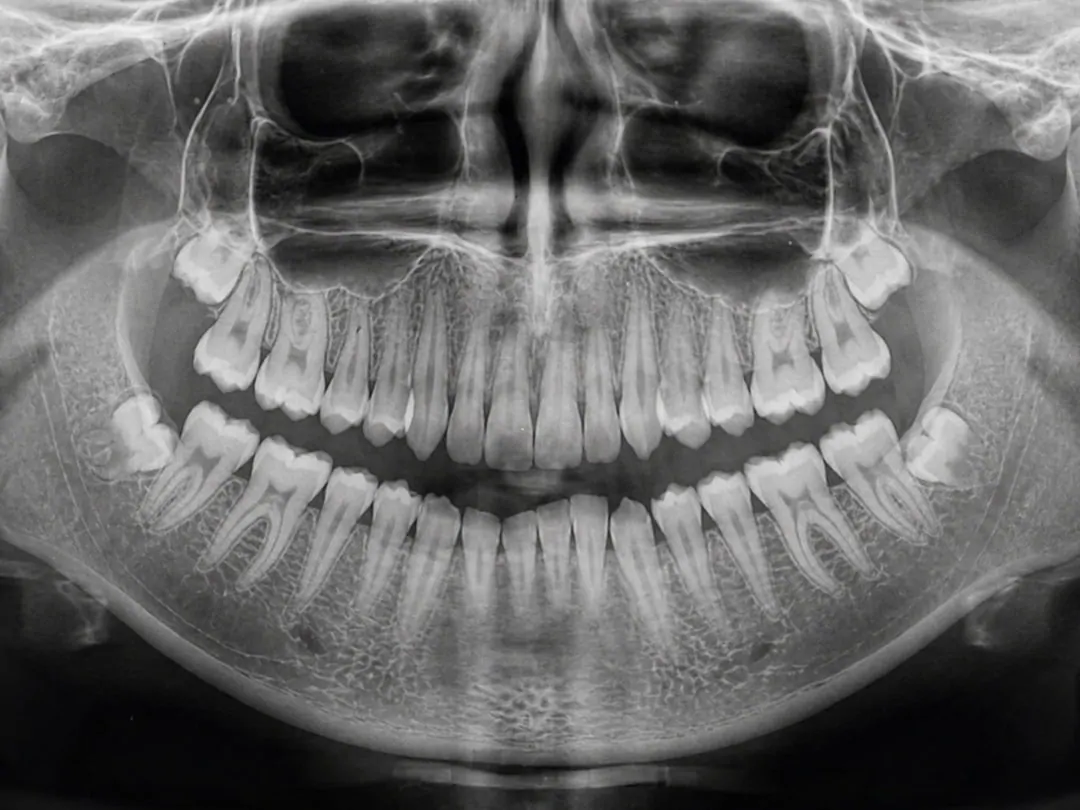 full lower jaw dental implants