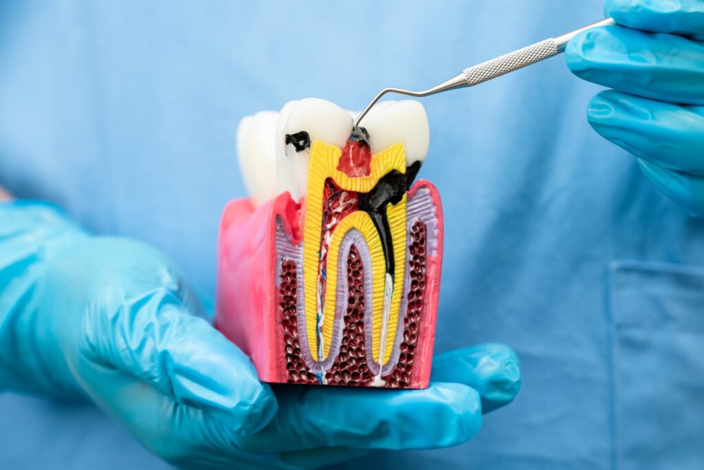 how to avoid root canal pain