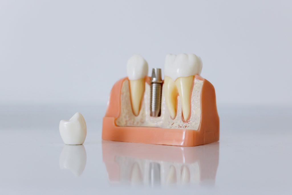 best way to get dental implants