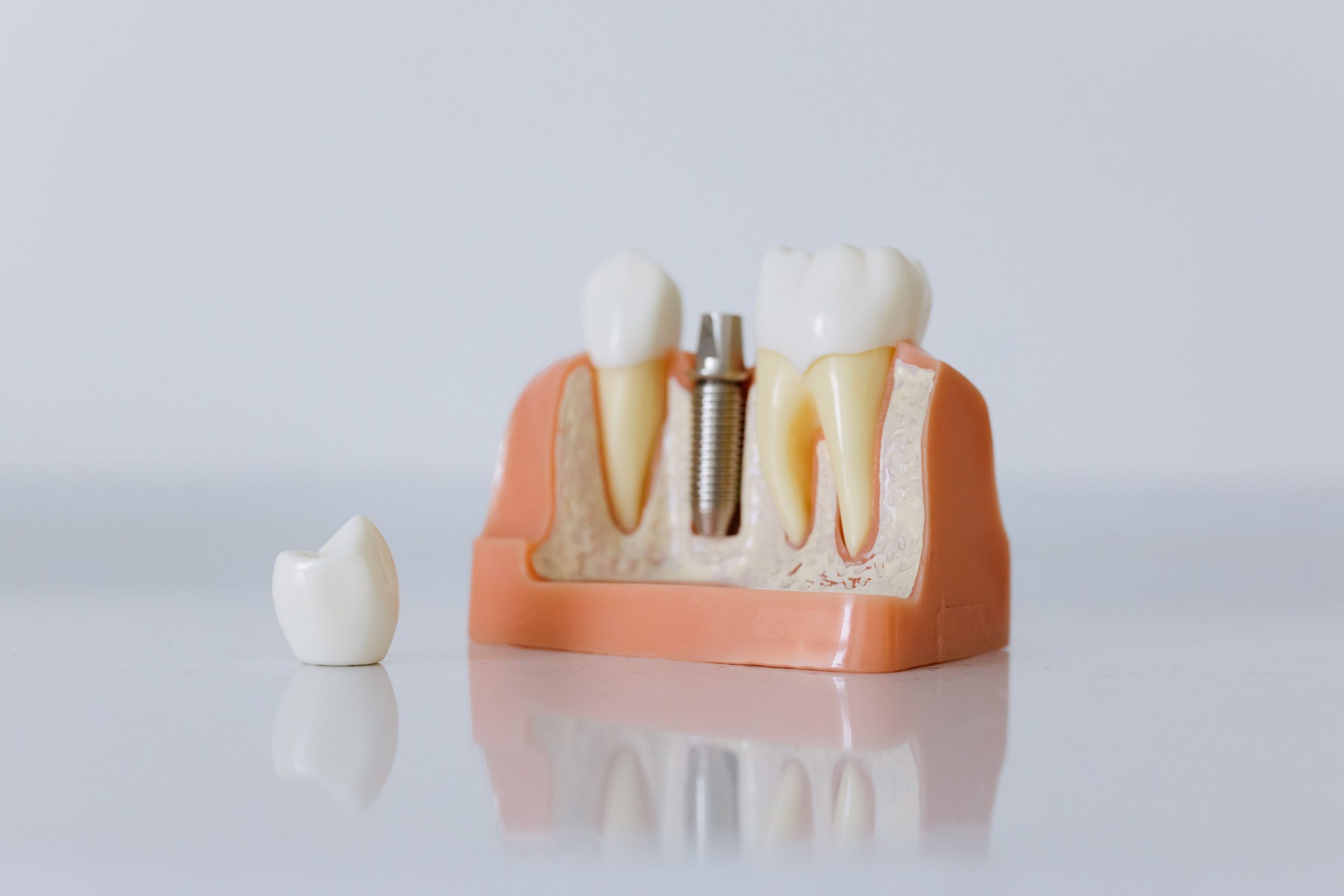 best way to get dental implants