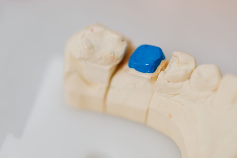 dental bridge restoration